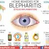 Top Home Remedies To Fight Against Blepharitis ( An Eyelid Inflammation )